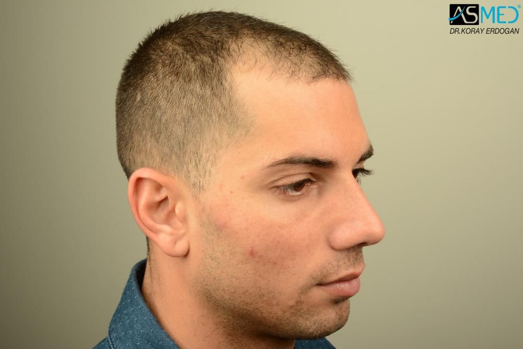 Quello che la prova deve esser fatta se i capelli principali abbandonano